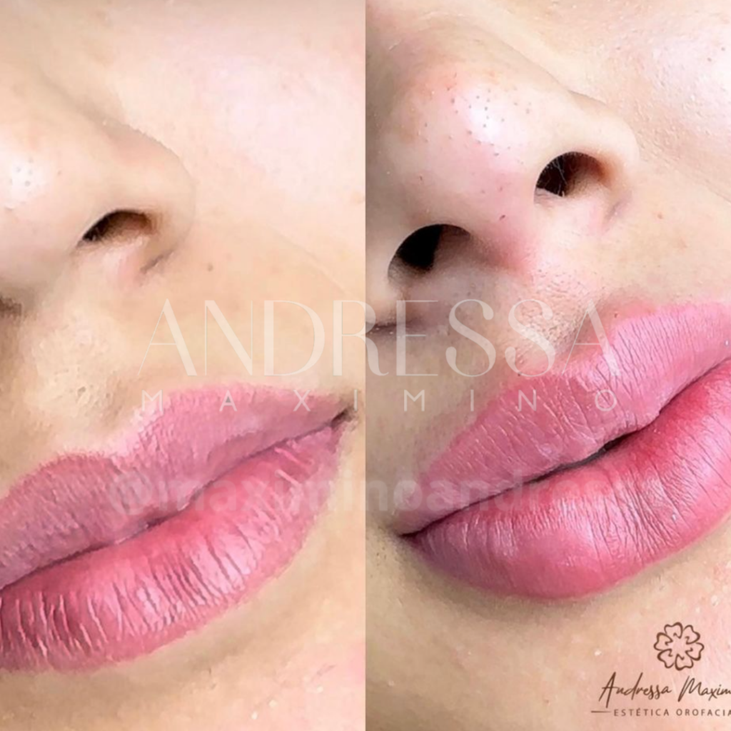 Antes e depois do tratamento de harmonização labial realizado pela Dra. Andressa Maximino