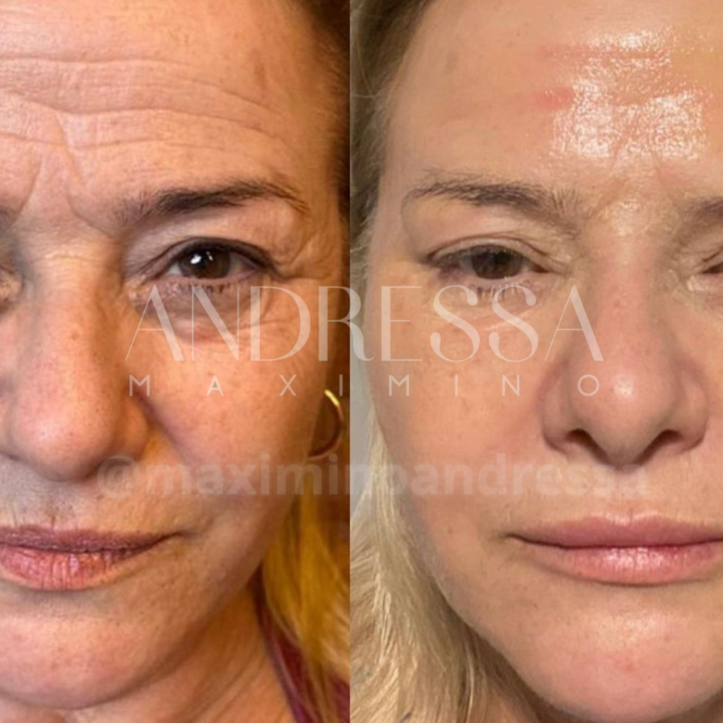 Antes e depois do tratamento de rejuvenescimento facial pela Dra. Andressa Maximino