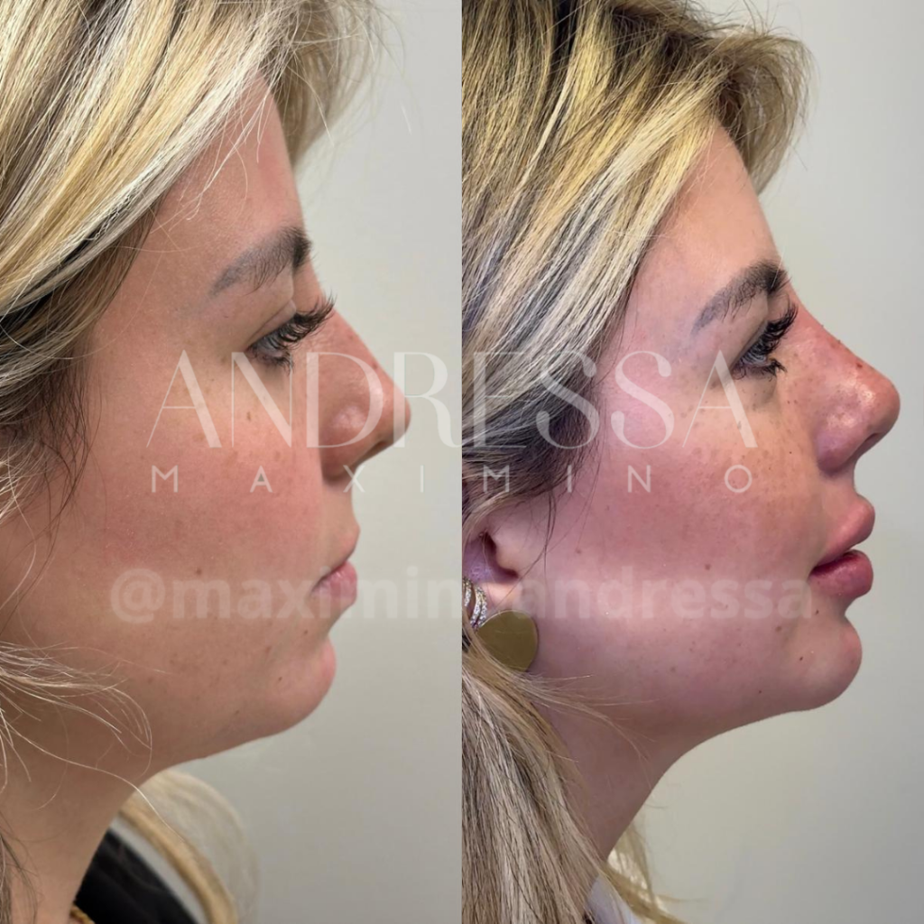 Antes e depois do tratamento de harmonização facial e aprimoramento nasal pela Dra. Andressa Maximino