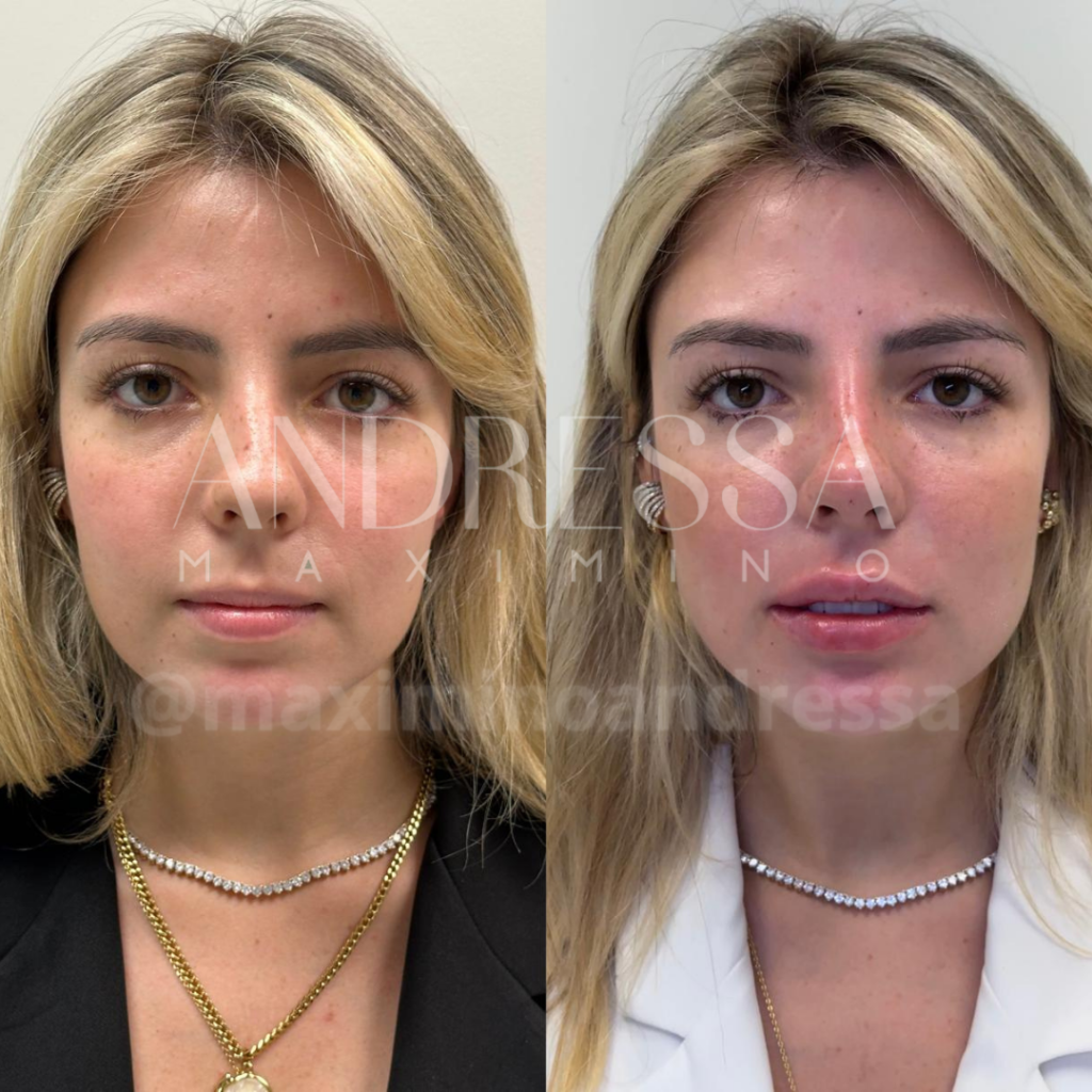 Antes e depois do tratamento de harmonização facial com foco na estética pela Dra. Andressa Maximino