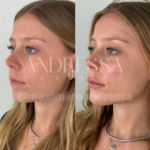 Resultados antes e depois do tratamento de harmonização facial pela Dra. Andressa Maximino