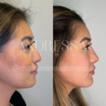 Antes e depois do tratamento de harmonização facial com contorno e refinamento pela Dra. Andressa Maximino