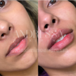 Antes e depois do tratamento de harmonização labial pela Dra. Andressa Maximino