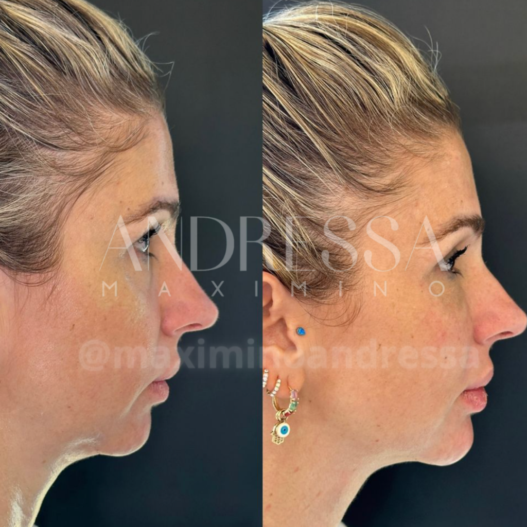Antes e depois do tratamento de harmonização facial com contorno e refinamento pela Dra. Andressa Maximino