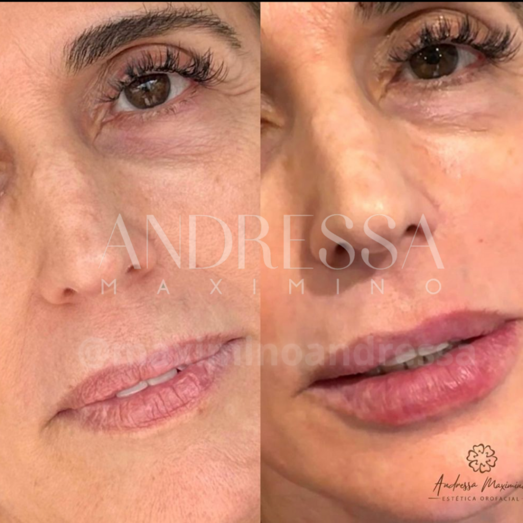 Antes e depois do tratamento de rejuvenescimento facial pela Dra. Andressa Maximino