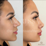 Antes e depois do tratamento estético facial realizado pela Dra. Andressa Maximino